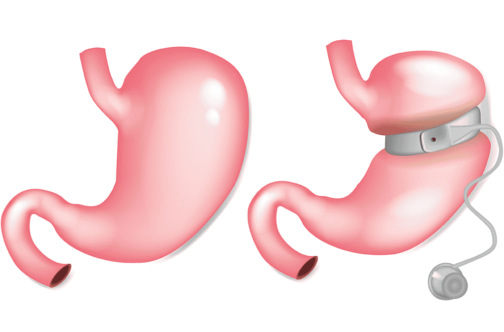 How does a gastric band work?