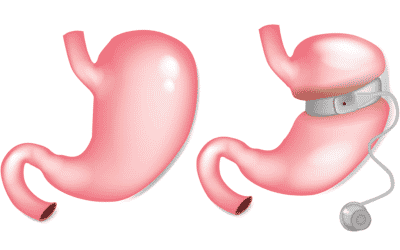 How does a gastric band work?