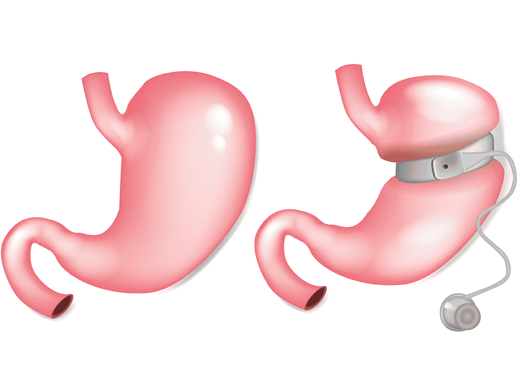 Gastric-band-what-is-a-gastric-band-post Gastric Band Support & Aftercare Drawing